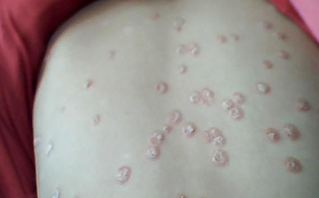 银屑病应该如何自我检查呢